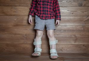 Club Foot In Infants Reasons Signs Remedies