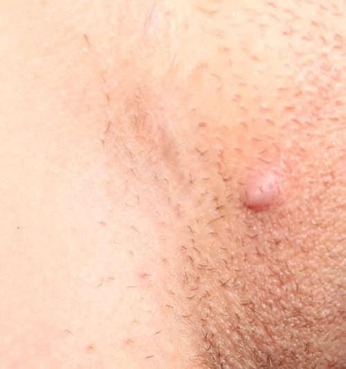 home remedies for ingrown hair