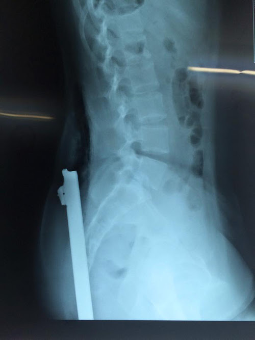 Nữ sinh bị thanh sắt trên xe ba bánh đâm xuyên người - 1