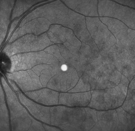 Mewds Multiple Evanescent White Dot Syndrome Retina Associates