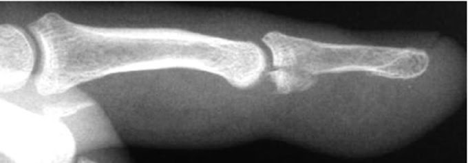 Nail Bed Avulsion - Distal phalanx (finger) fracture - WikEM / Because the nail is not as firmly attached at the base or lunule as it is to the distal nail bed, the flexion injury avulsed only the base, and the proximal .