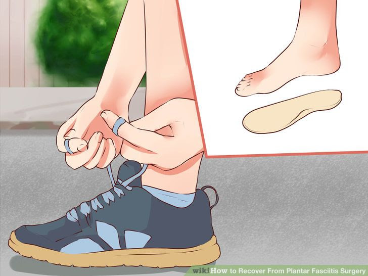 Recover From Plantar Fasciitis Surgery Step 12.jpg