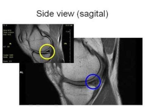 Learn who it is an effective treatment for. How to Read an MRI of Torn Meniscus | Meniscal Tear