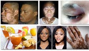 Gaya Terbaru 29+ Cara Mengobati Vitiligo Dengan Jahe