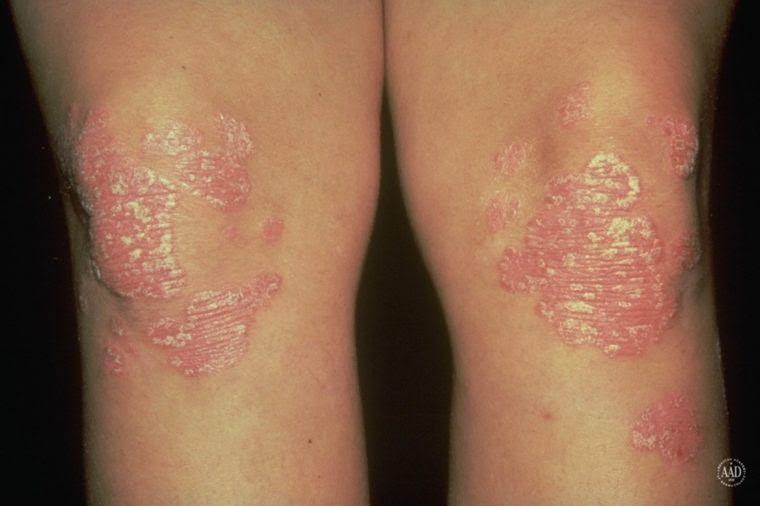 Psoriasis