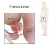 Prostate Cancer Adalah - Metastatic Prostate Cancer Irish Cancer Society / Despite this, pancreatic cancer is among the deadliest types of cancer, which is why it's extremely important to know and recogni.