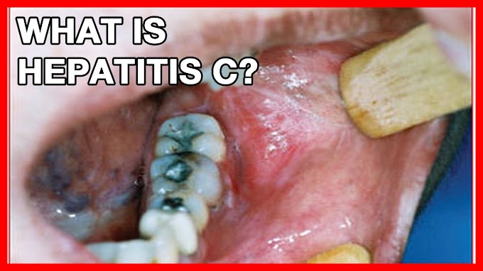 Hepatitis B Symptome Chronisch / Hepatitis B: Ursachen, Symptome und Therapie - It can remain silent until there is severe damage to your liver.