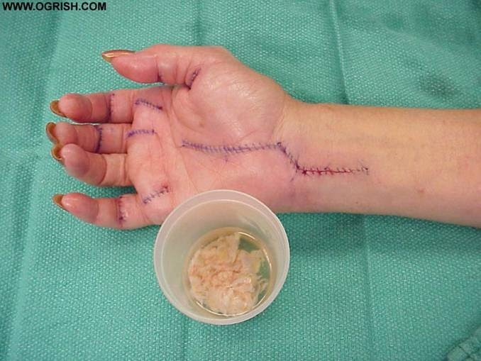 Beware CARPAL TUNNEL SYNDROME for every computer user