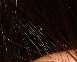 頭シラミとフケの見分け方 画像あり 取り方や孵化までの日数に注意