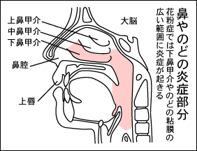 高崎の清水耳鼻咽喉科 鼻づまり めまい レーザー アレルギー 日帰り手術 鼻茸は当医院へ