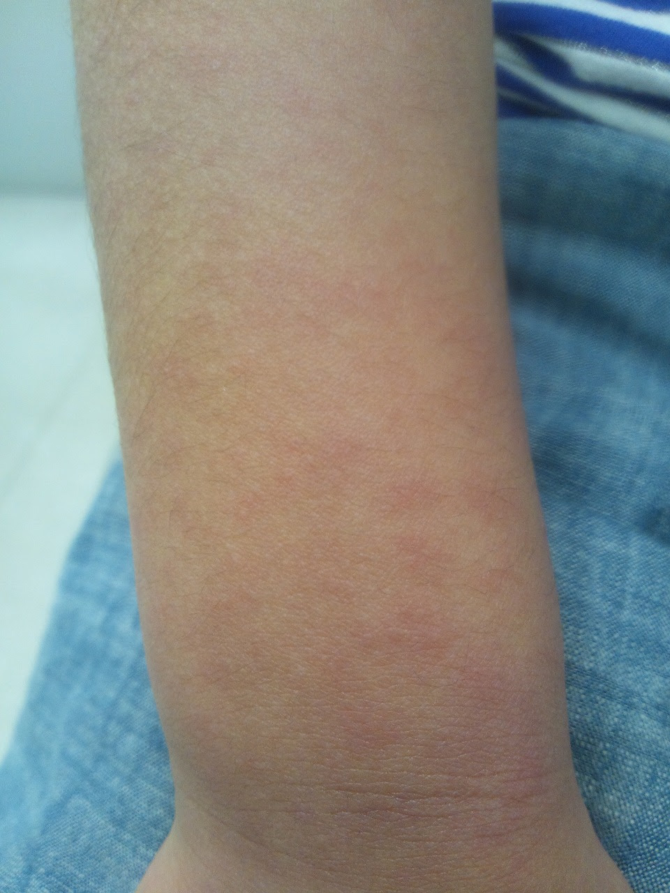 多形性滲出性紅斑