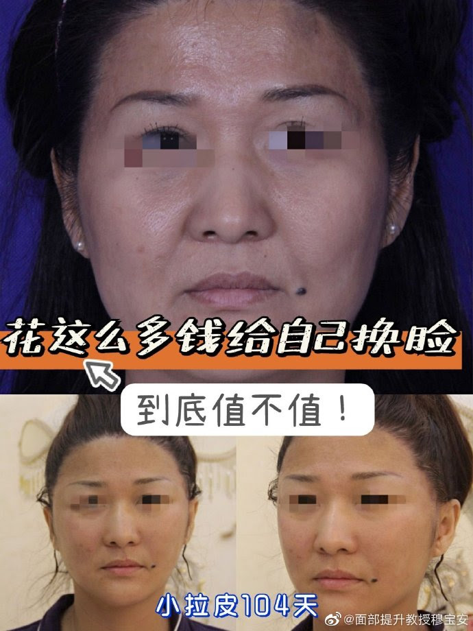 穆宝安对比杨大平谁做面部拉皮提升做的好？ - 整容资讯网