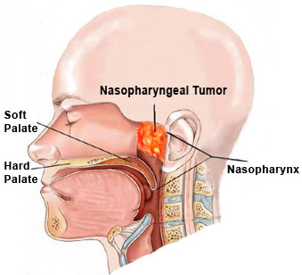Berbeda dengan kanker payudara yang bisa diraba, kanker Nasofaring  sangat susah diraba. Kanker Nasofaring masuk lima besar tumor ganas yang sering dijumpai di Indonesia.