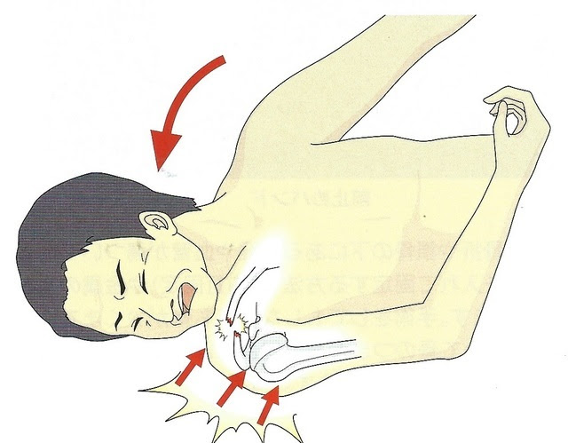 鎖骨骨折 久美接骨院 名古屋市中村区