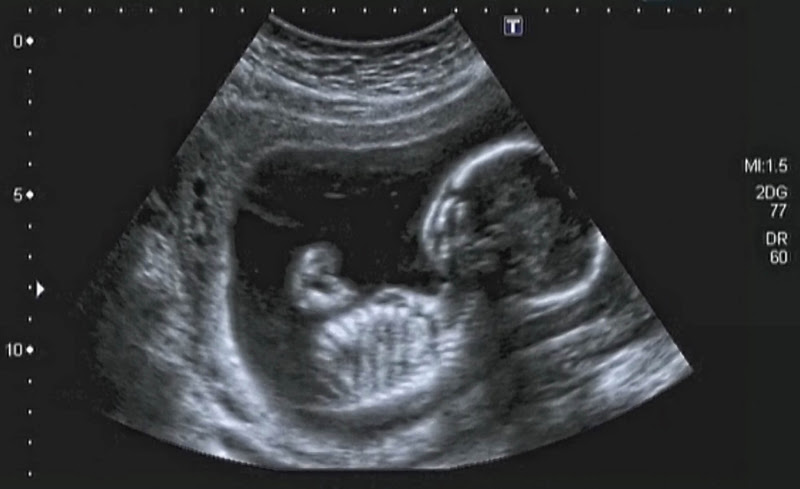 妊娠19週で性別判明 自分で気づいてしまった時の衝撃は大 ゼクシィbaby 妊娠 出産 育児 みんなの体験記