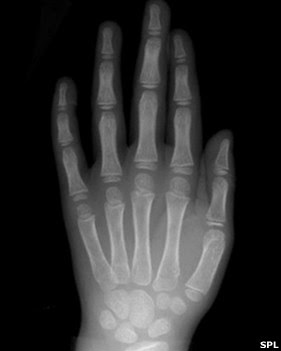 Radiografía de una mano