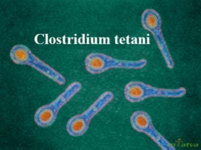 tetanus symptom   mtatva health pie