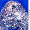 Mesothelioma Cancer Lung / The Costs and Complexity of Emphysema Treatment | ELG Law - Learn about this uncommon cancer that's linked to asbestos.