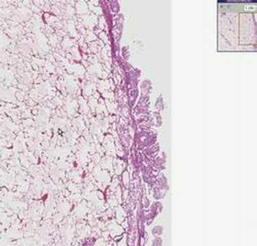 Foto Mesothelioma Lung
