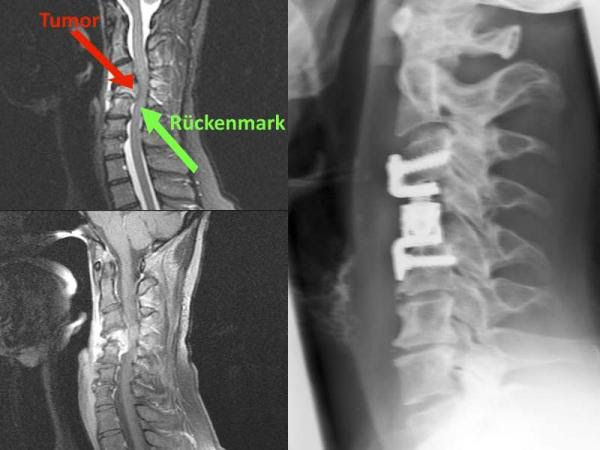 Symptome tumor wirbelsaule