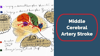 Middle Cerebral Artery Stroke Treatment
