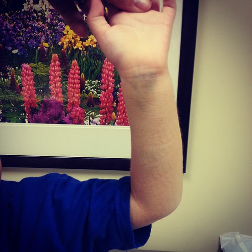 And some bruises!