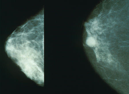 http://upload.wikimedia.org/wikipedia/commons/f/f6/Mammo_breast_cancer.jpg