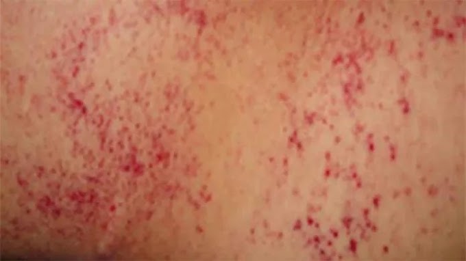 Types Skin Cancer Most Deadly : Squamous cell skin cancer : © 2021 mjh life sciences and pharmacy times.