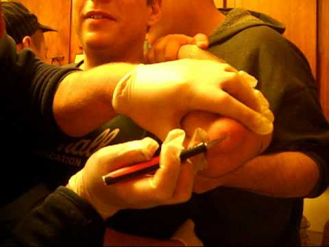 Olecranon Bursitis (Popeye Elbow) Cigna