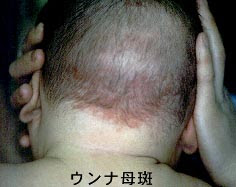 母斑症 あざ