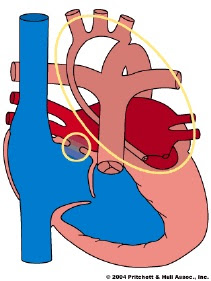 Hypoplastic Left Heart Syndrome Hlhs Children S Minnesota