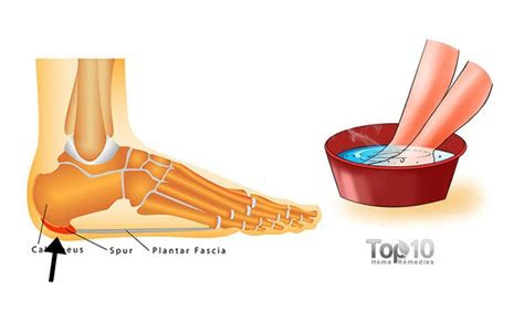 To revisit this article, visit my profile, thenview saved stories. Home Remedies for Heel Spurs | Top 10 Home Remedies
