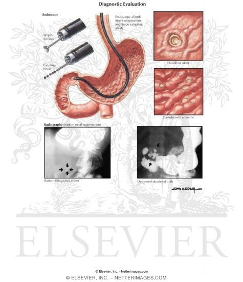 Peptic Ulcer Disease. of Peptic Ulcer Disease
