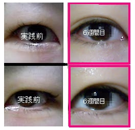 簡単に二重まぶたになる方法