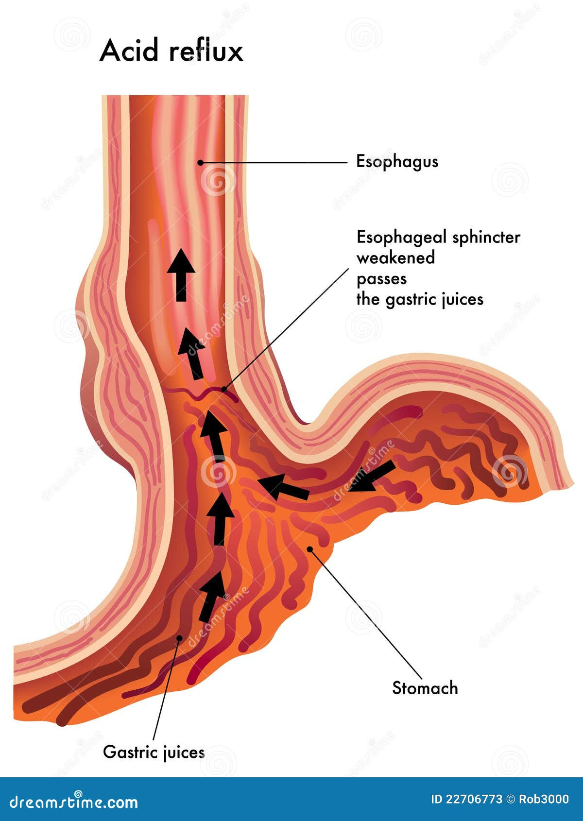  com/how-to-differentiate-between-acid-reflux-and-bile-reflux-718.html