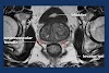Prostate Cancer Staging Radiology Assistant - Ultrasound guided prostate biopsy | Image | Radiopaedia.org