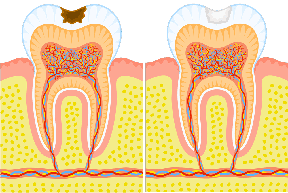 Traitement des caries - centre medico-dentaire balexert geneve