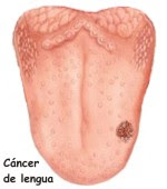 lesiones cancerigenas en boca