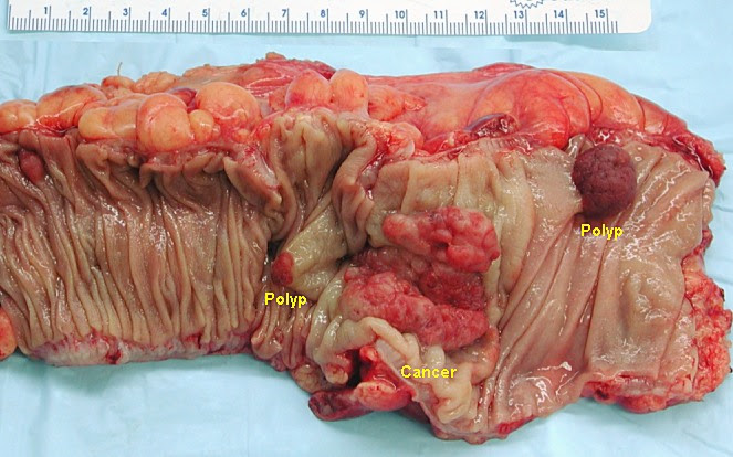 rayon most cancers effet secondaire