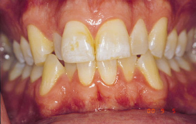 This white area had to be both bleached and sanded, while the brown 