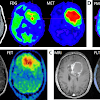 Prostate Cancer With Metastasis - Liver Atlas: Case 60: Metastasis - Gallbladder Cancer - Prostate cancer is a common type of cancer in men, according to the mayo clinic.