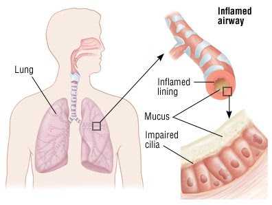 common inhalers for bronchitis