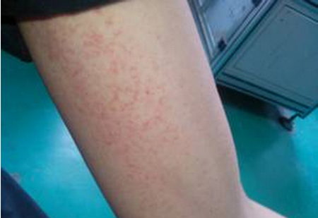 艾滋病小红点特征 万图壁纸网