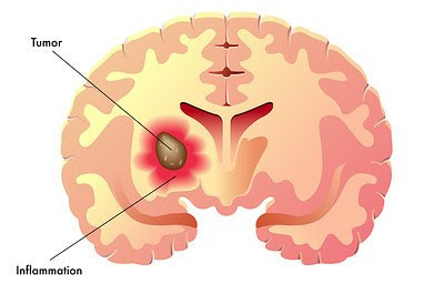 brain tumor