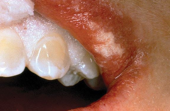 The Dangers of DIY Teeth Whitening Kits - Stourbridge Dental &amp; Implant 