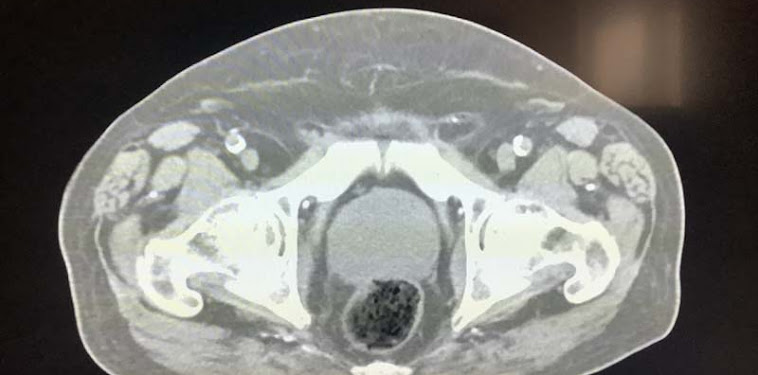 Prostate Cancer Symptoms Urinary Retention : Urinary problems after prostate cancer treatment Urology of Virginia