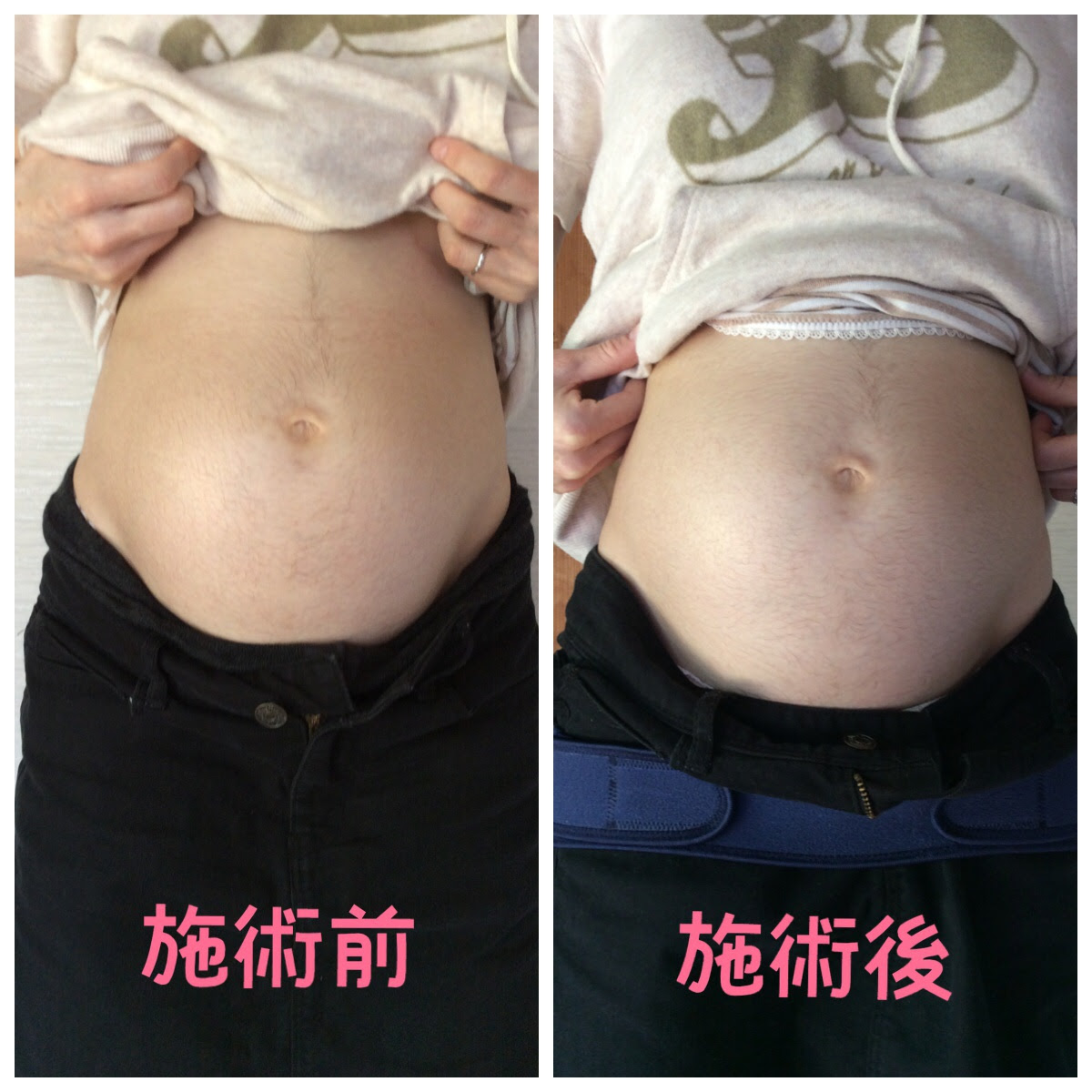 骨盤ケアで切迫早産妊婦さんのお腹が柔らかく上がった 詩音助産院