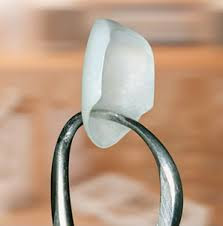 fort worth dental veneers, santa cruz dental veneers, boulder dental veneers, dental veneers fort worth, dental veneers grapevine, la jolla dental veneers, monterey dental veneers, salinas dental veneers, santa cruz county dental veneers, dental veneers boston 