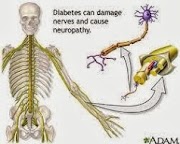 15+ Cara Mengobati Penyakit Neuropati Perifer Secara Alami