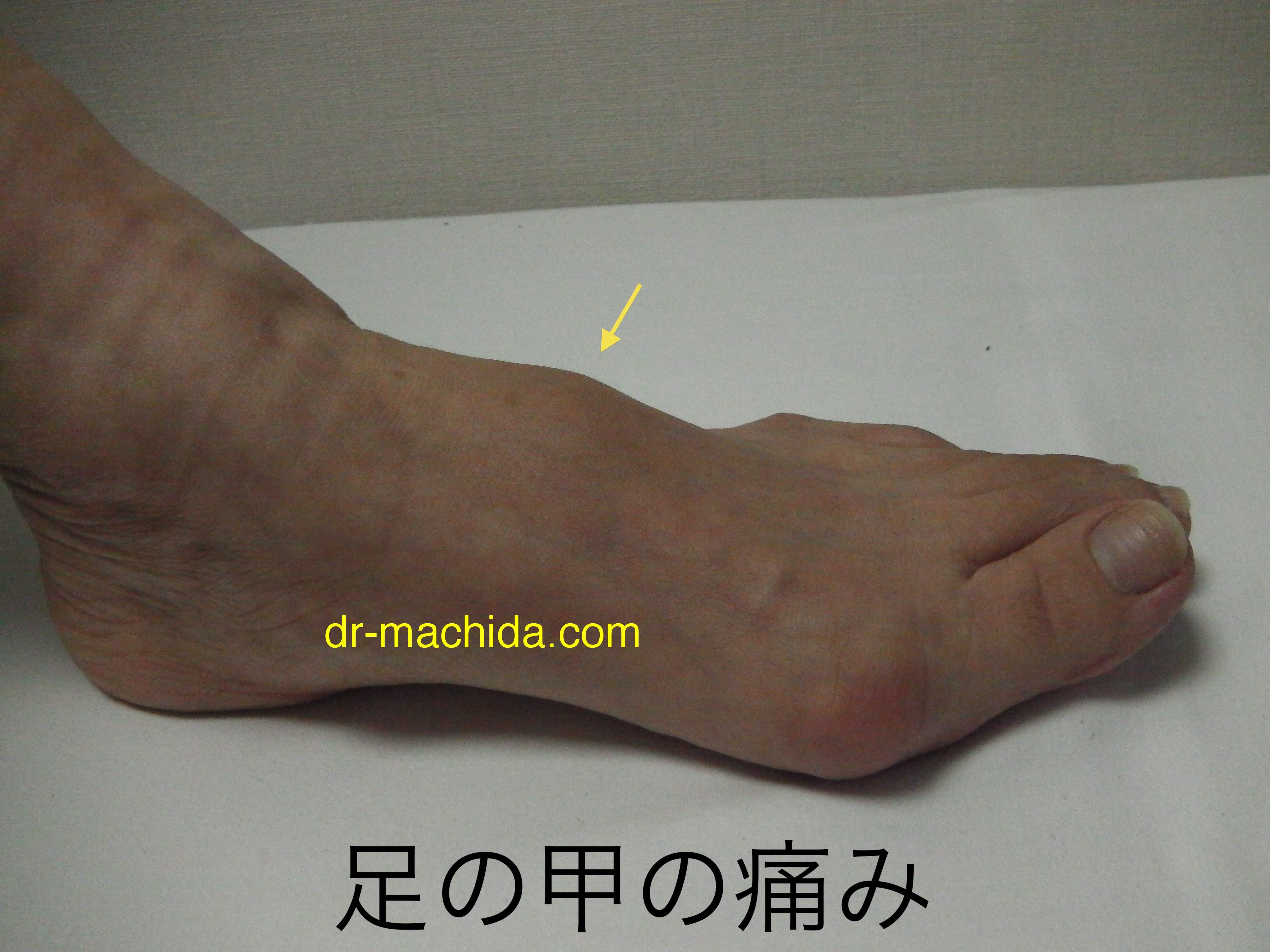 足の甲の痛みに関する質問集